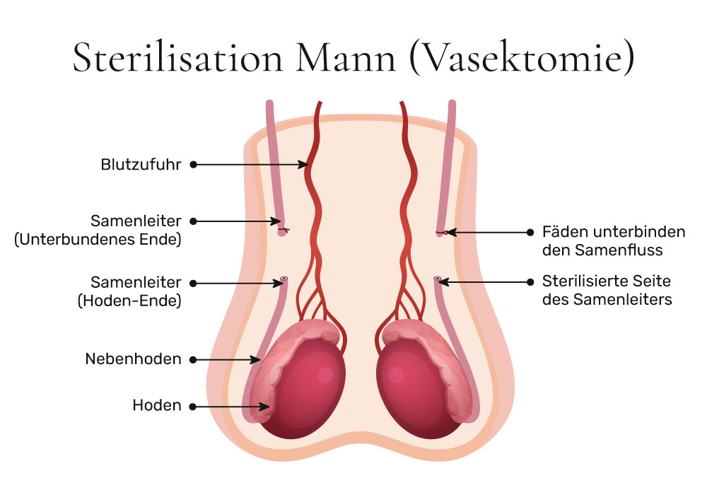 Vasektomie: Vorteile und Nachteile im Überblick 2 Vasektomie: Vorteile und Nachteile im Überblick