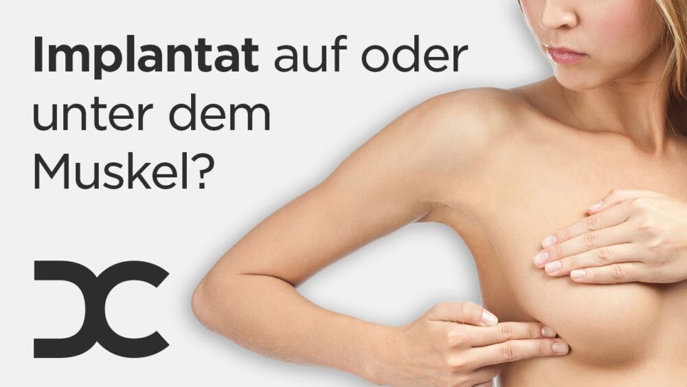 Vorteile und Nachteile von Implantaten über dem Brustmuskel: Alles, was Sie wissen müssen 1 Vorteile und Nachteile von Implantaten über dem Brustmuskel: Alles, was Sie wissen müssen